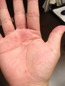 赤い斑点 手 【放置NG】手のひらに赤い斑点！肝臓が悪いサイン「手掌紅斑」かも